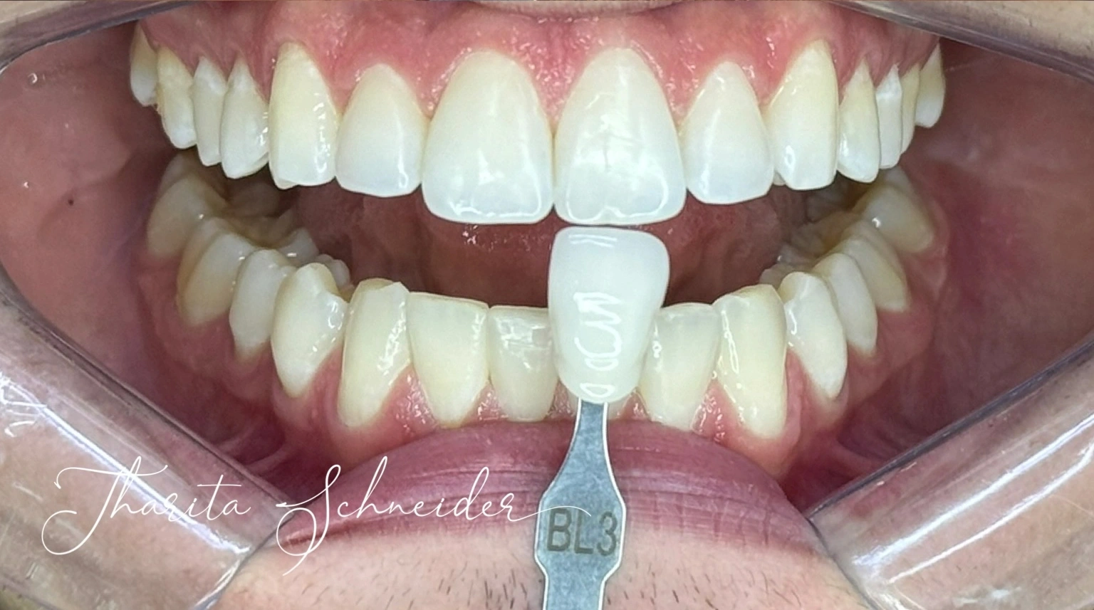 Antes — Clareamento Dental